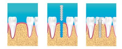 Implant dentaire dentiste Evreux